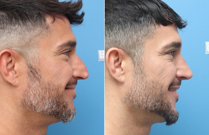 Rhinoplasty Before & After Gallery - Patient 264447 - Image 1
