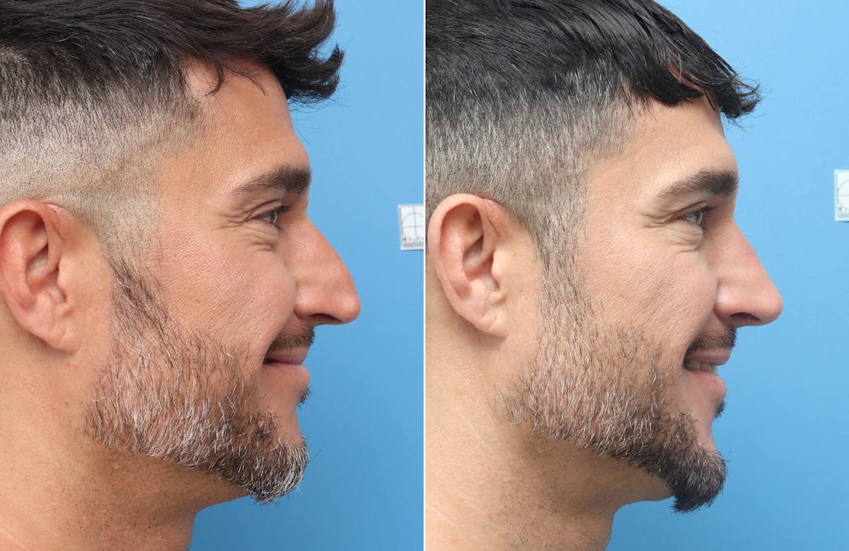 Rhinoplasty Before & After Gallery - Patient 264447 - Image 1