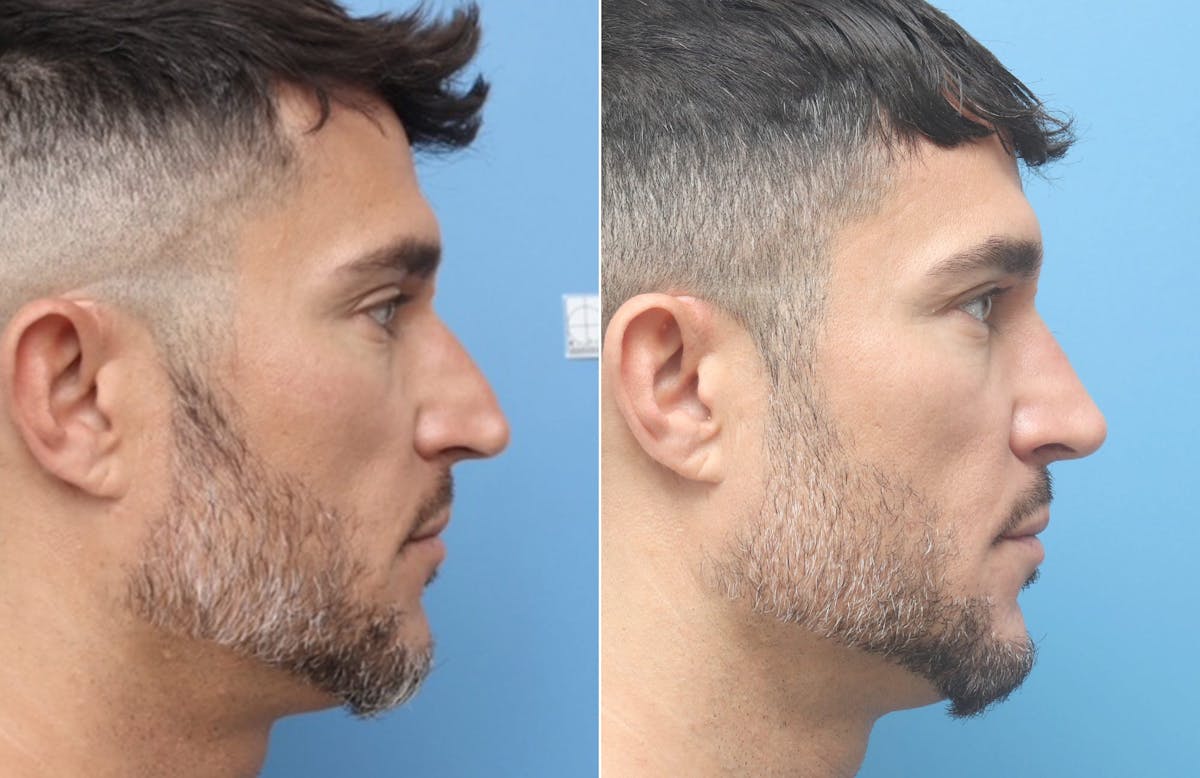 Rhinoplasty Before & After Gallery - Patient 264447 - Image 2