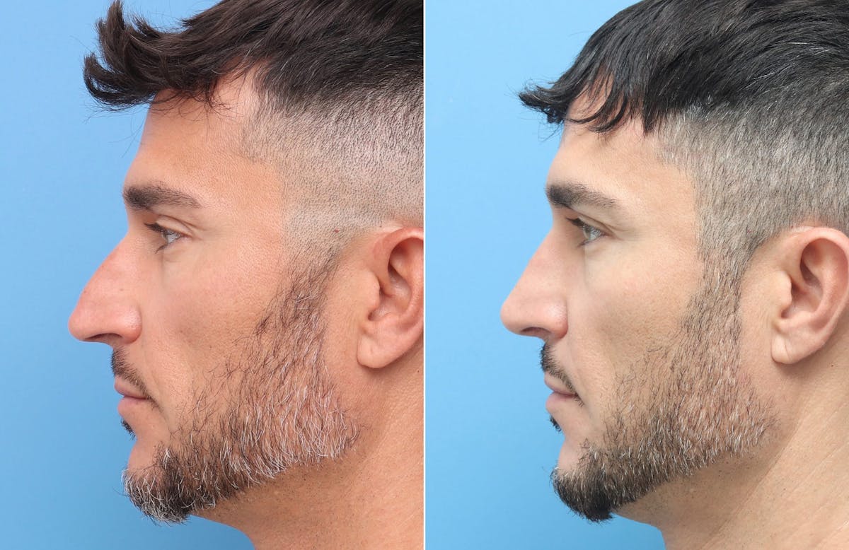 Rhinoplasty Before & After Gallery - Patient 264447 - Image 6
