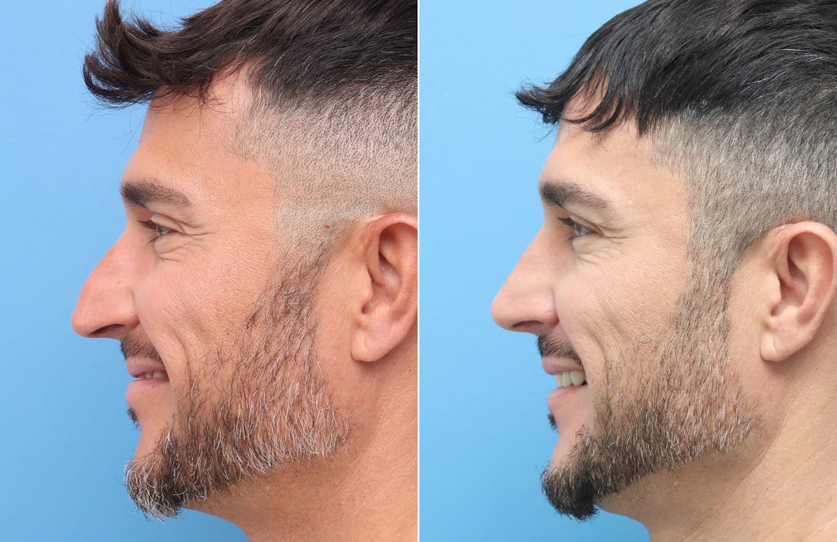 Rhinoplasty Before & After Gallery - Patient 264447 - Image 7