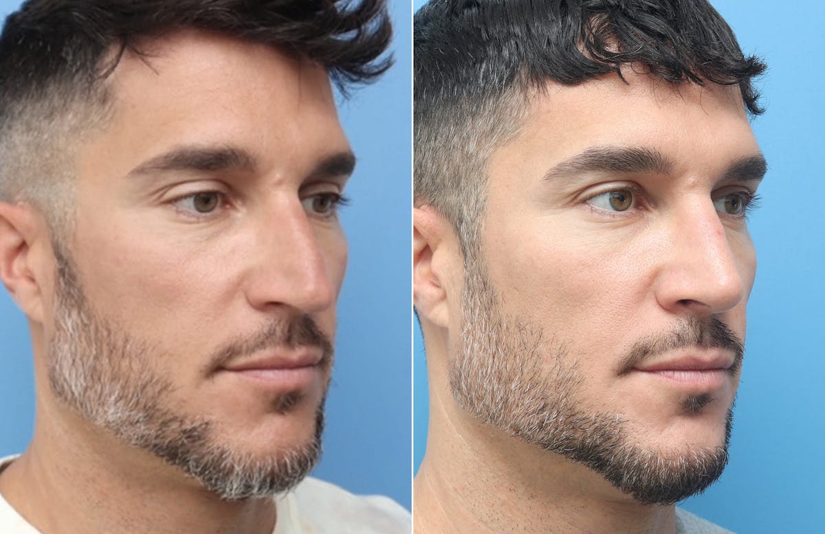 Rhinoplasty Before & After Gallery - Patient 264447 - Image 5