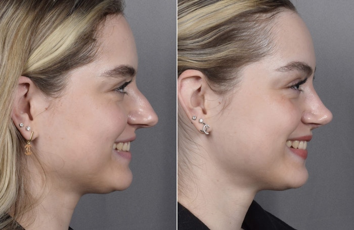 Rhinoplasty Before & After Gallery - Patient 423592 - Image 1
