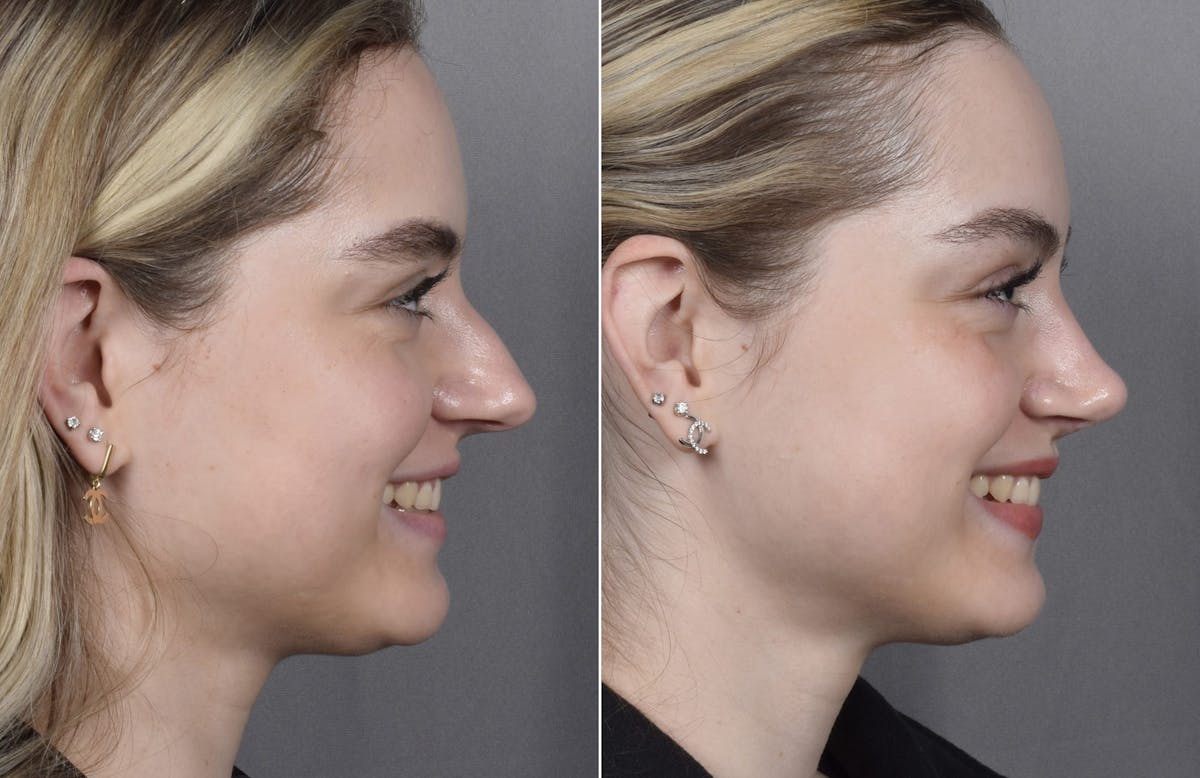 Rhinoplasty Before & After Gallery - Patient 423592 - Image 1