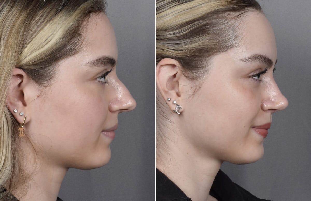 Rhinoplasty Before & After Gallery - Patient 423592 - Image 3