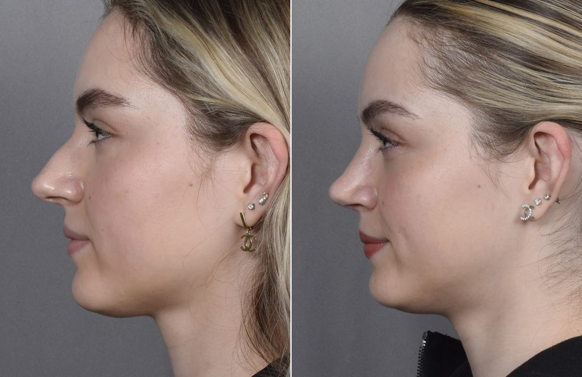 Rhinoplasty Before & After Gallery - Patient 423592 - Image 6