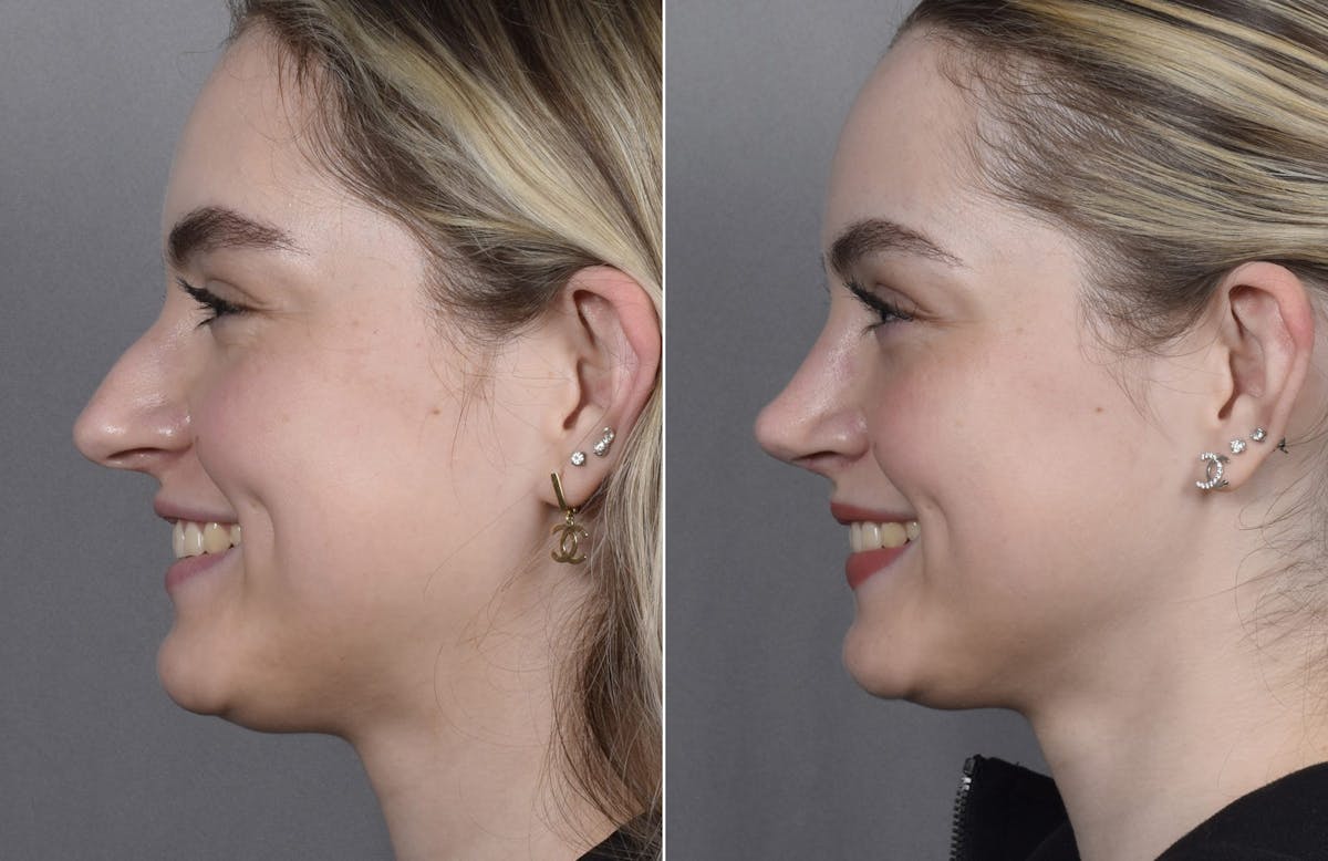 Rhinoplasty Before & After Gallery - Patient 423592 - Image 7