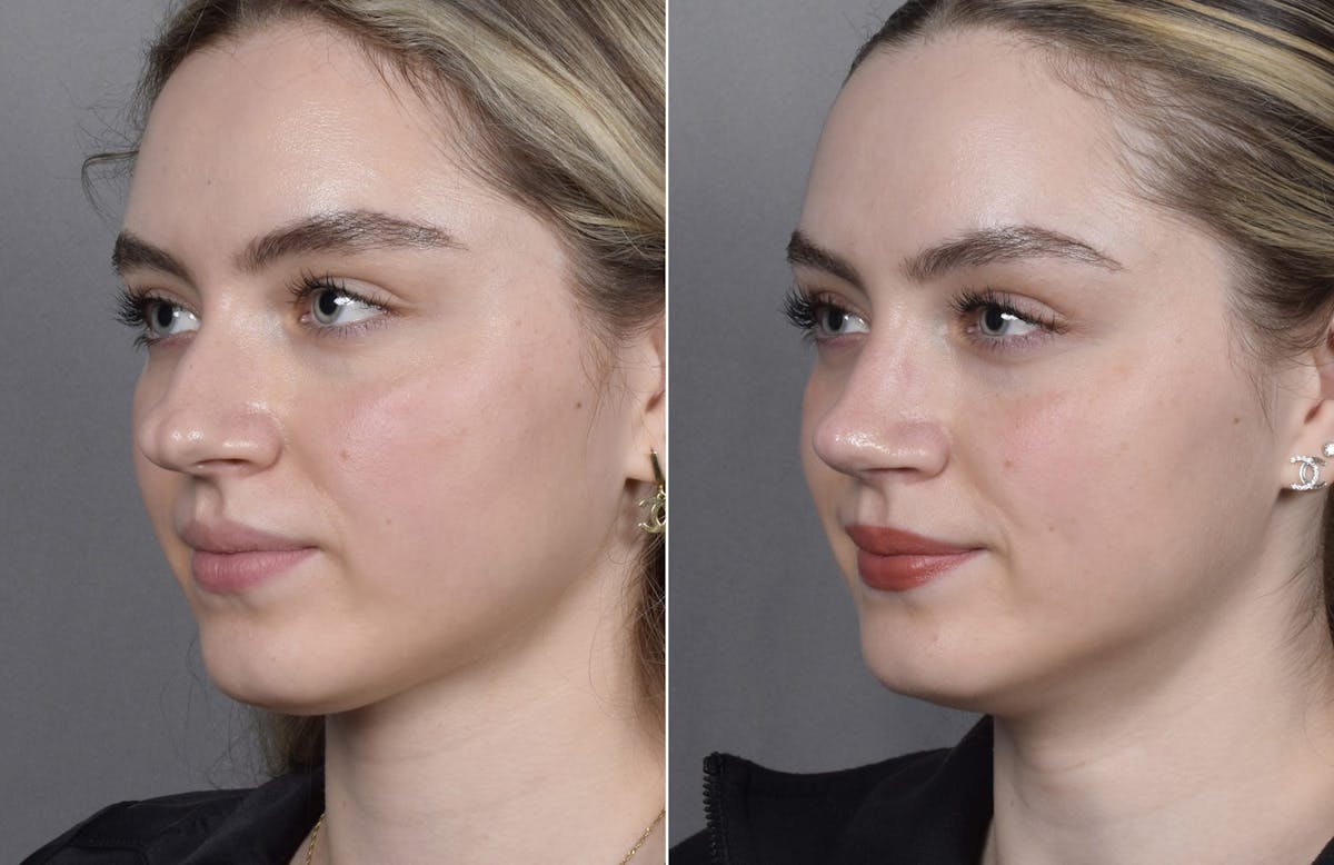 Rhinoplasty Before & After Gallery - Patient 423592 - Image 5