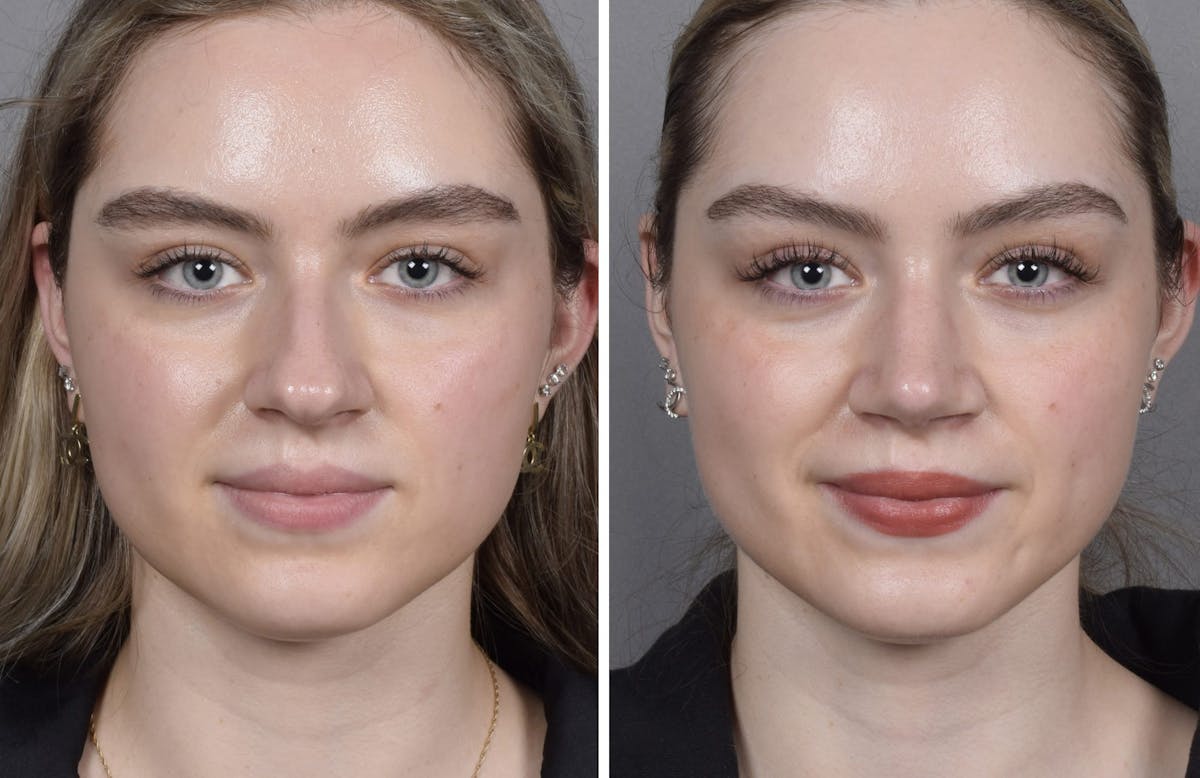 Rhinoplasty Before & After Gallery - Patient 423592 - Image 2