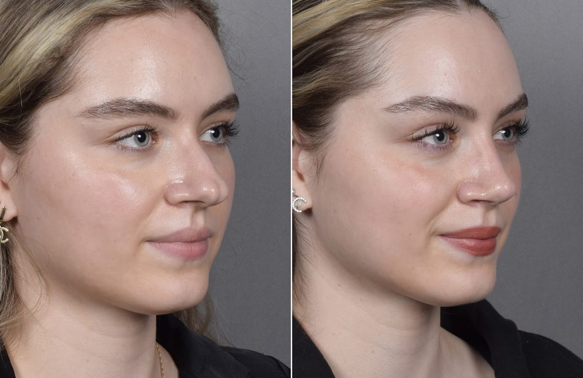 Rhinoplasty Before & After Gallery - Patient 423592 - Image 4
