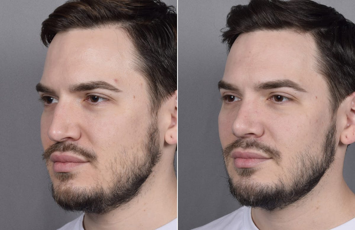 Rhinoplasty Before & After Gallery - Patient 147686 - Image 4