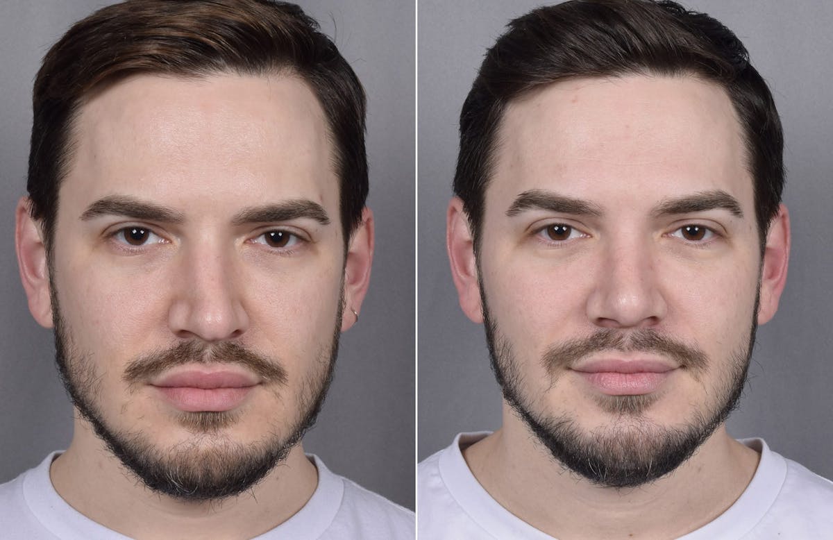 Rhinoplasty Before & After Gallery - Patient 147686 - Image 3
