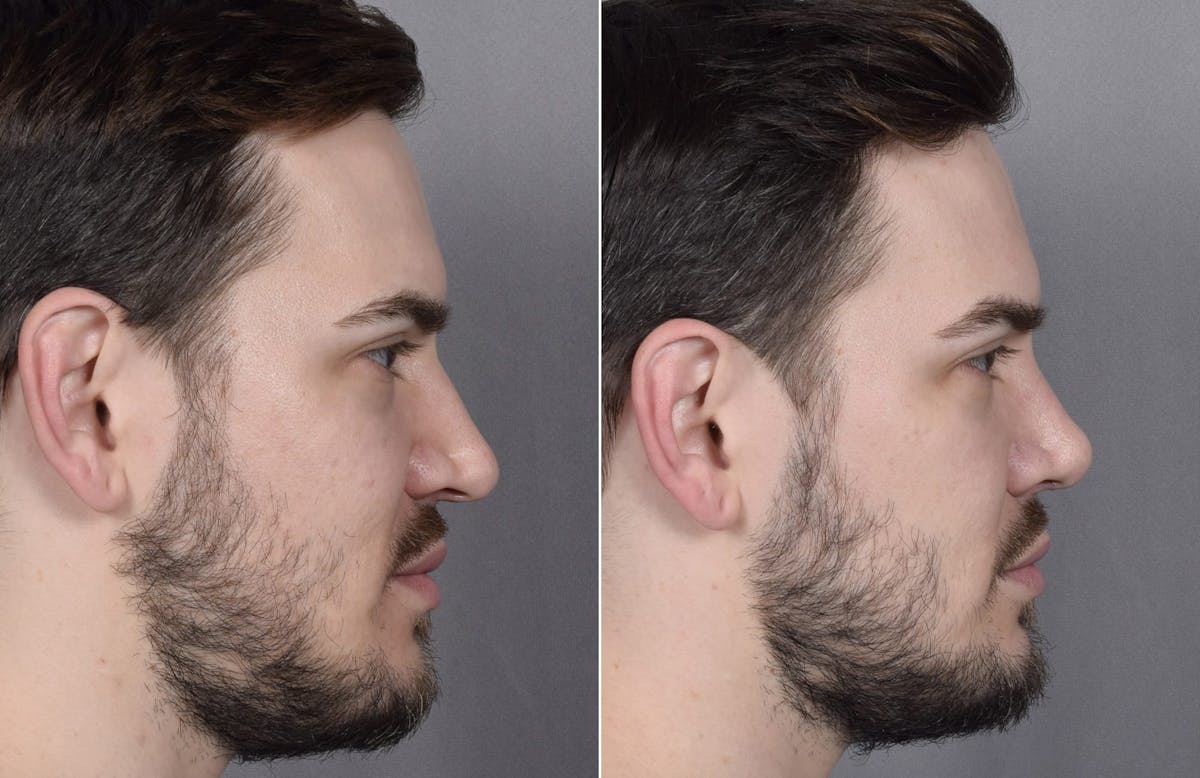 Rhinoplasty Before & After Gallery - Patient 147686 - Image 2