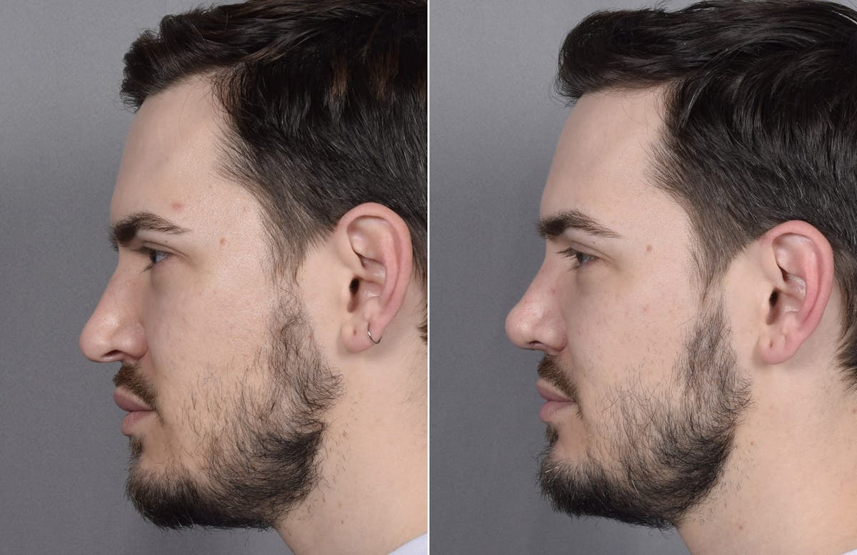 Rhinoplasty Before & After Gallery - Patient 147686 - Image 6