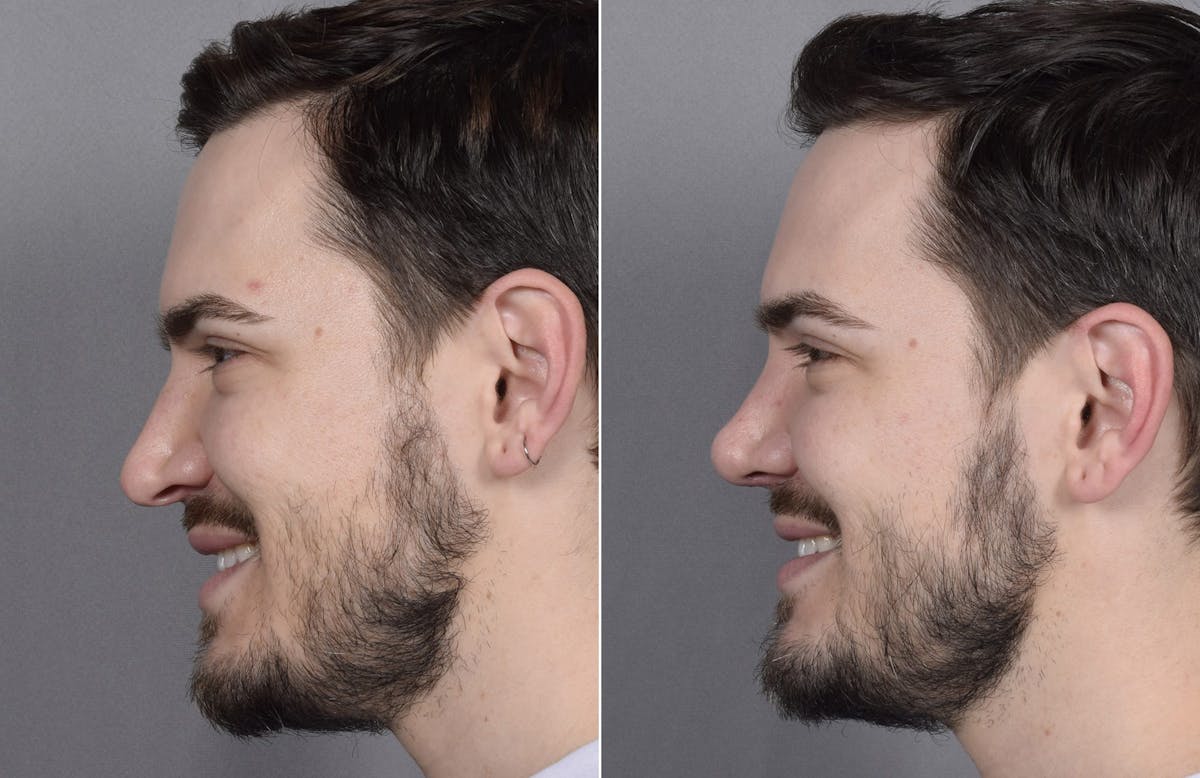 Rhinoplasty Before & After Gallery - Patient 147686 - Image 7