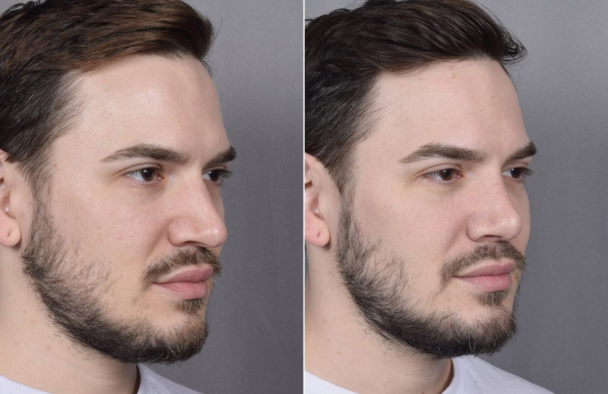 Rhinoplasty Before & After Gallery - Patient 147686 - Image 5