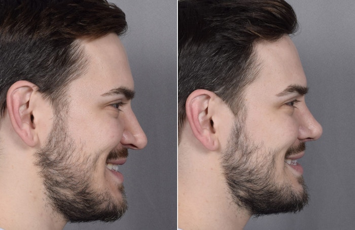 Rhinoplasty Before & After Gallery - Patient 147686 - Image 1