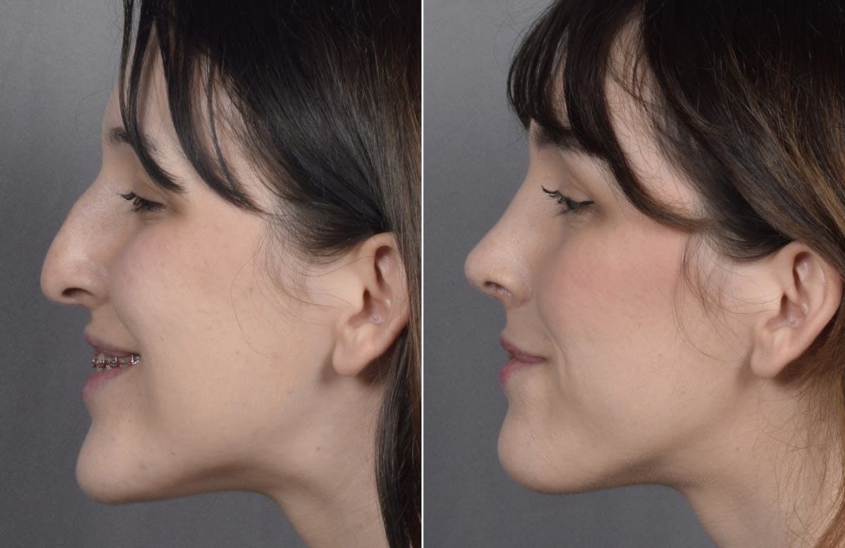 Rhinoplasty Before & After Gallery - Patient 885575 - Image 6