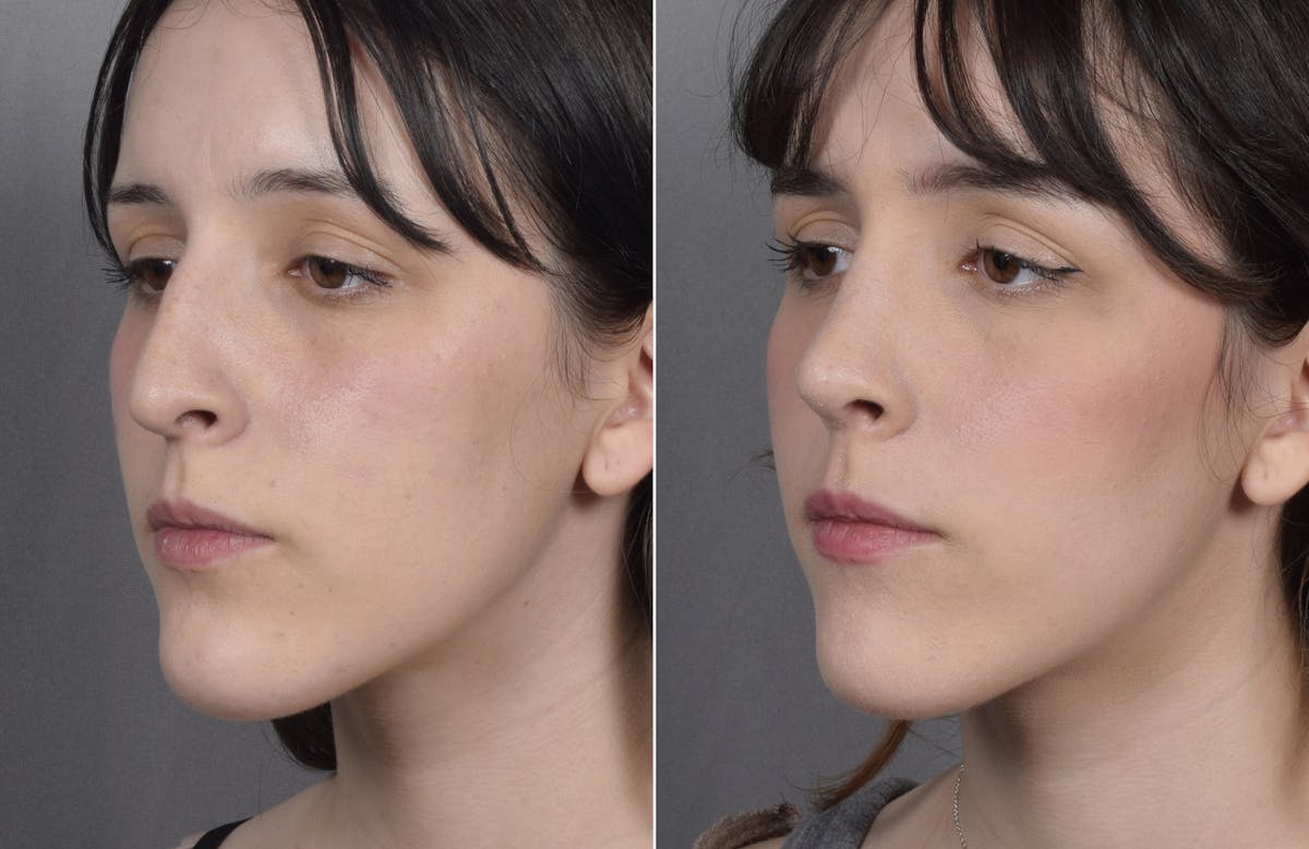 Rhinoplasty Before & After Gallery - Patient 885575 - Image 5