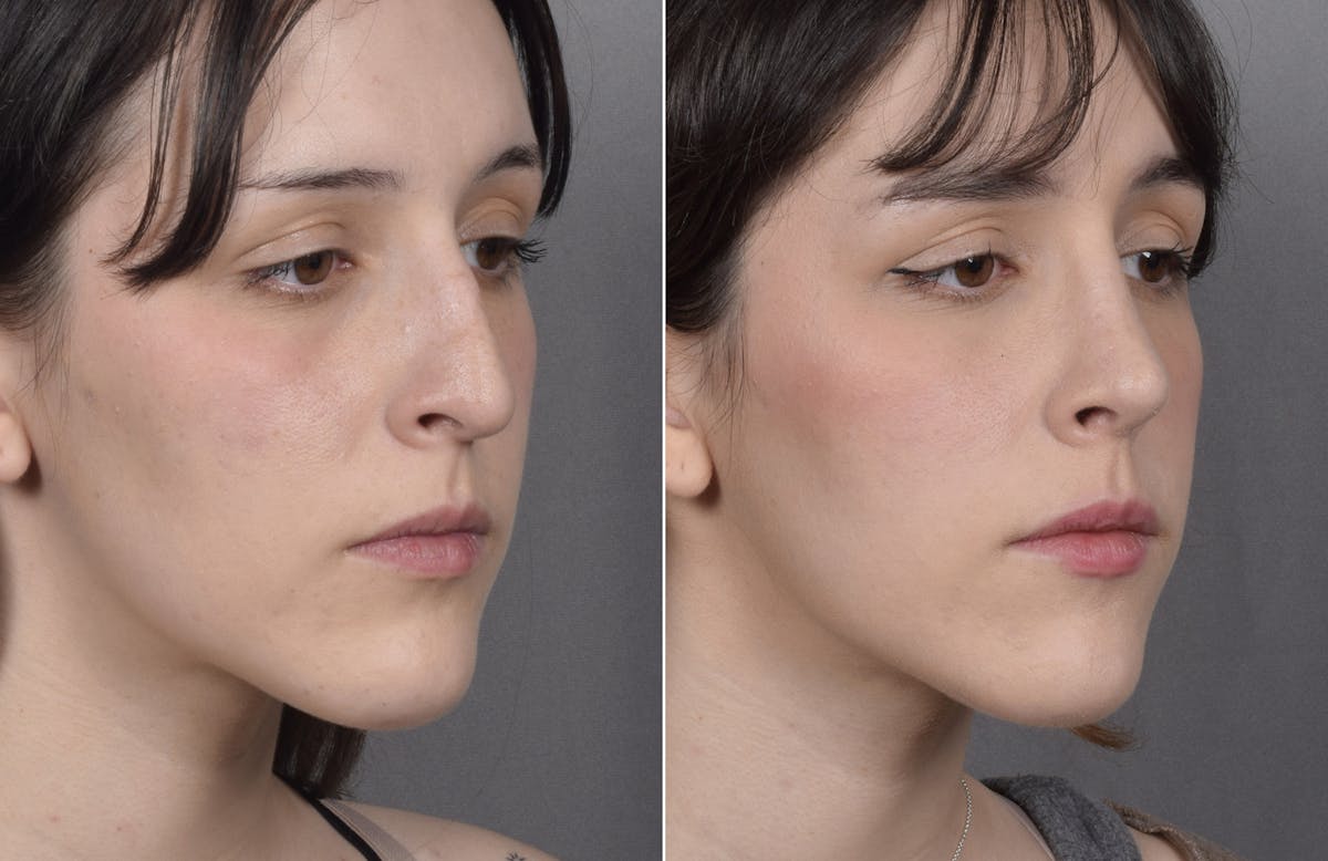 Rhinoplasty Before & After Gallery - Patient 885575 - Image 4