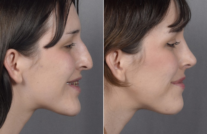 Rhinoplasty Before & After Gallery - Patient 885575 - Image 1