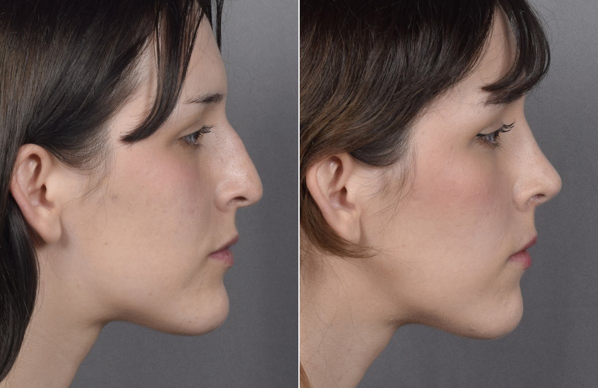 Rhinoplasty Before & After Gallery - Patient 885575 - Image 2