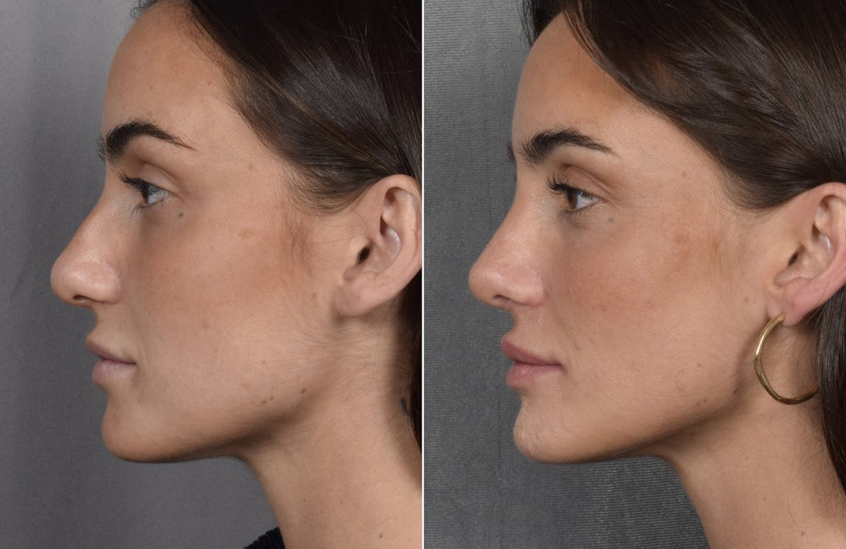 Rhinoplasty Before & After Gallery - Patient 315427 - Image 6