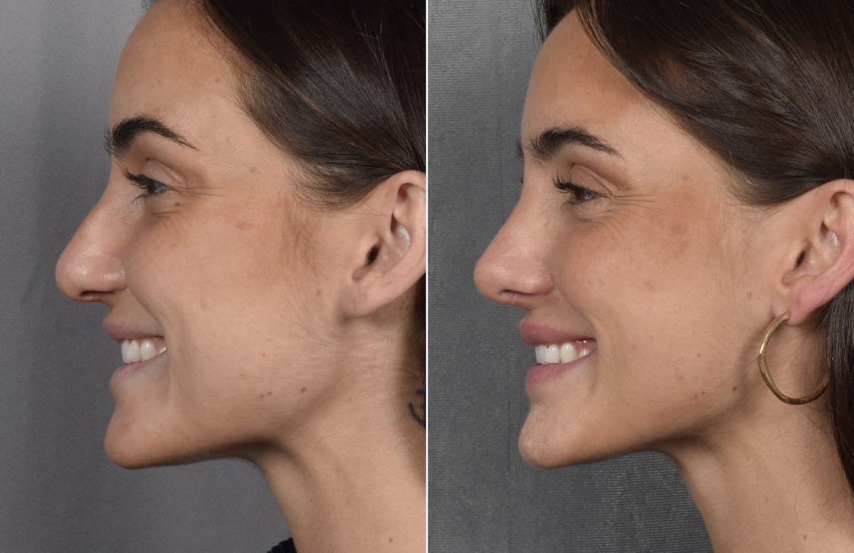 Rhinoplasty Before & After Gallery - Patient 315427 - Image 7