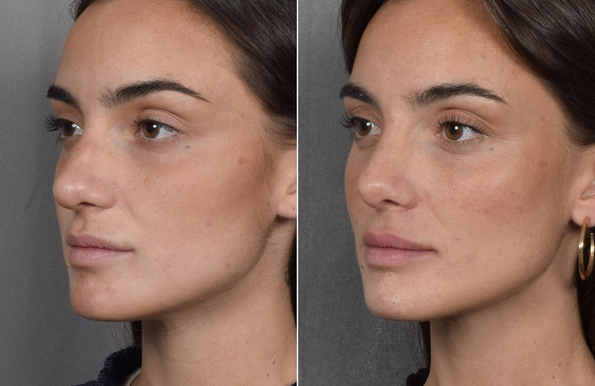 Rhinoplasty Before & After Gallery - Patient 315427 - Image 4
