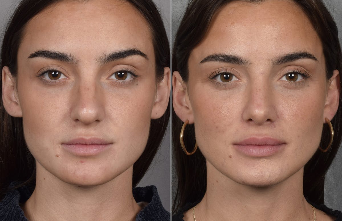 Rhinoplasty Before & After Gallery - Patient 315427 - Image 3