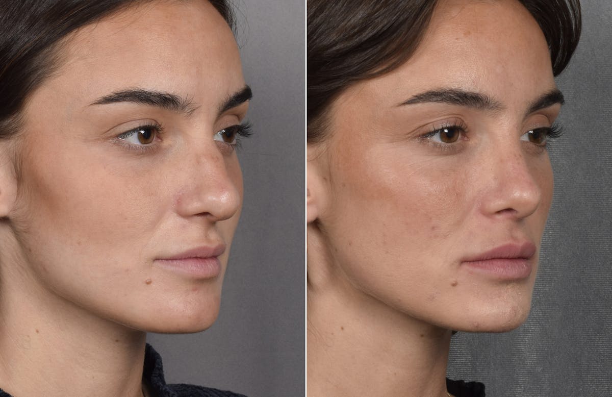 Rhinoplasty Before & After Gallery - Patient 315427 - Image 5