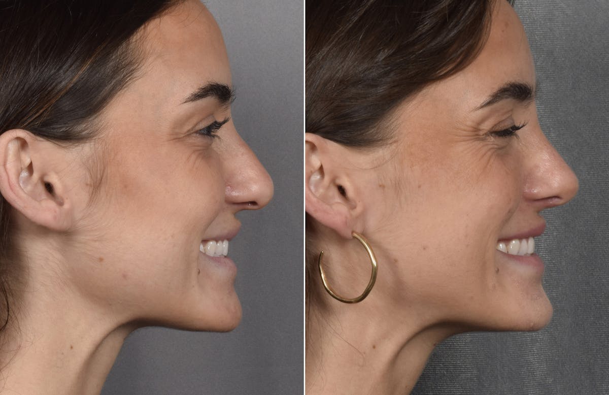Rhinoplasty Before & After Gallery - Patient 315427 - Image 1
