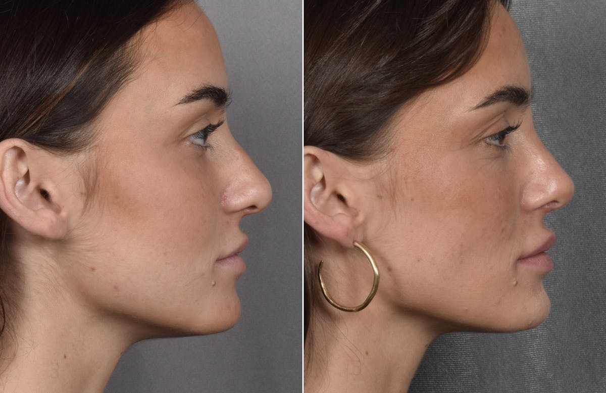 Rhinoplasty Before & After Gallery - Patient 315427 - Image 2