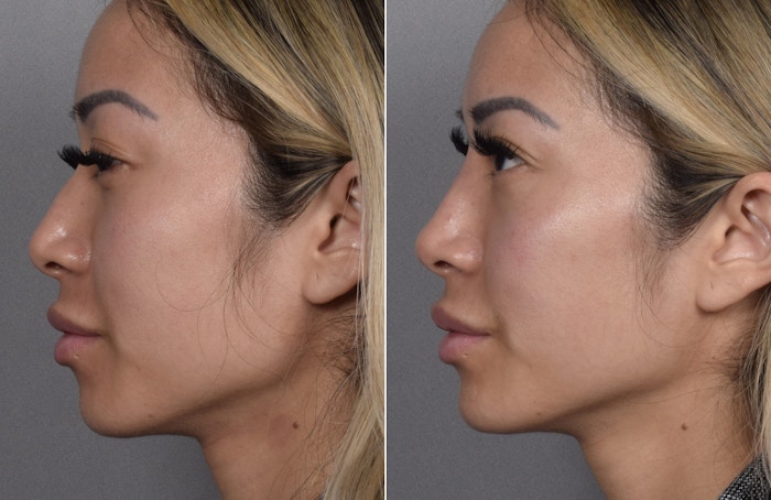 Non-Surgical Rhinoplasty Before & After Gallery - Patient 368742 - Image 1