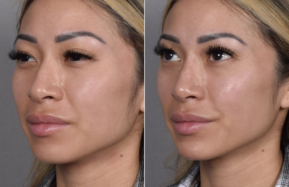 Non-Surgical Rhinoplasty Before & After Gallery - Patient 368742 - Image 2