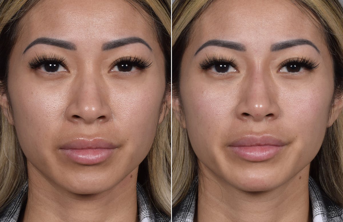 Non-Surgical Rhinoplasty Before & After Gallery - Patient 368742 - Image 5