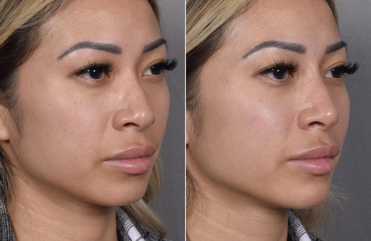 Non-Surgical Rhinoplasty Before & After Gallery - Patient 368742 - Image 3
