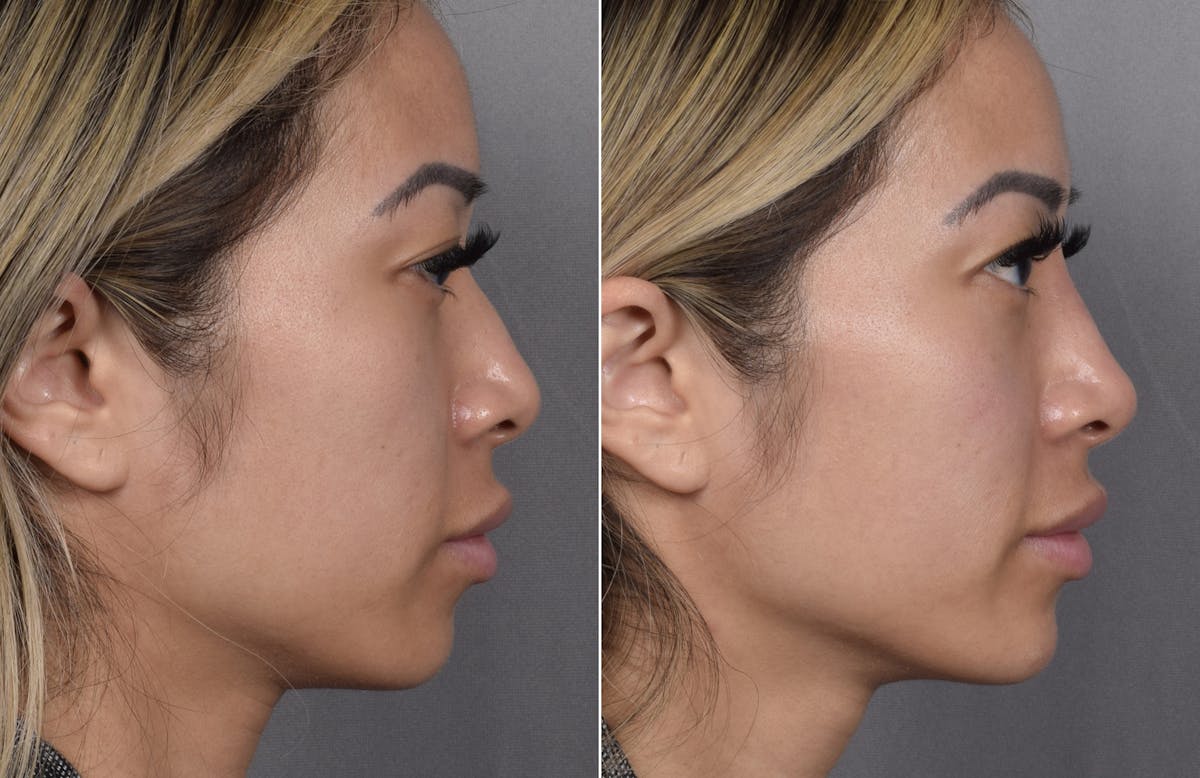 Non-Surgical Rhinoplasty Before & After Gallery - Patient 368742 - Image 4