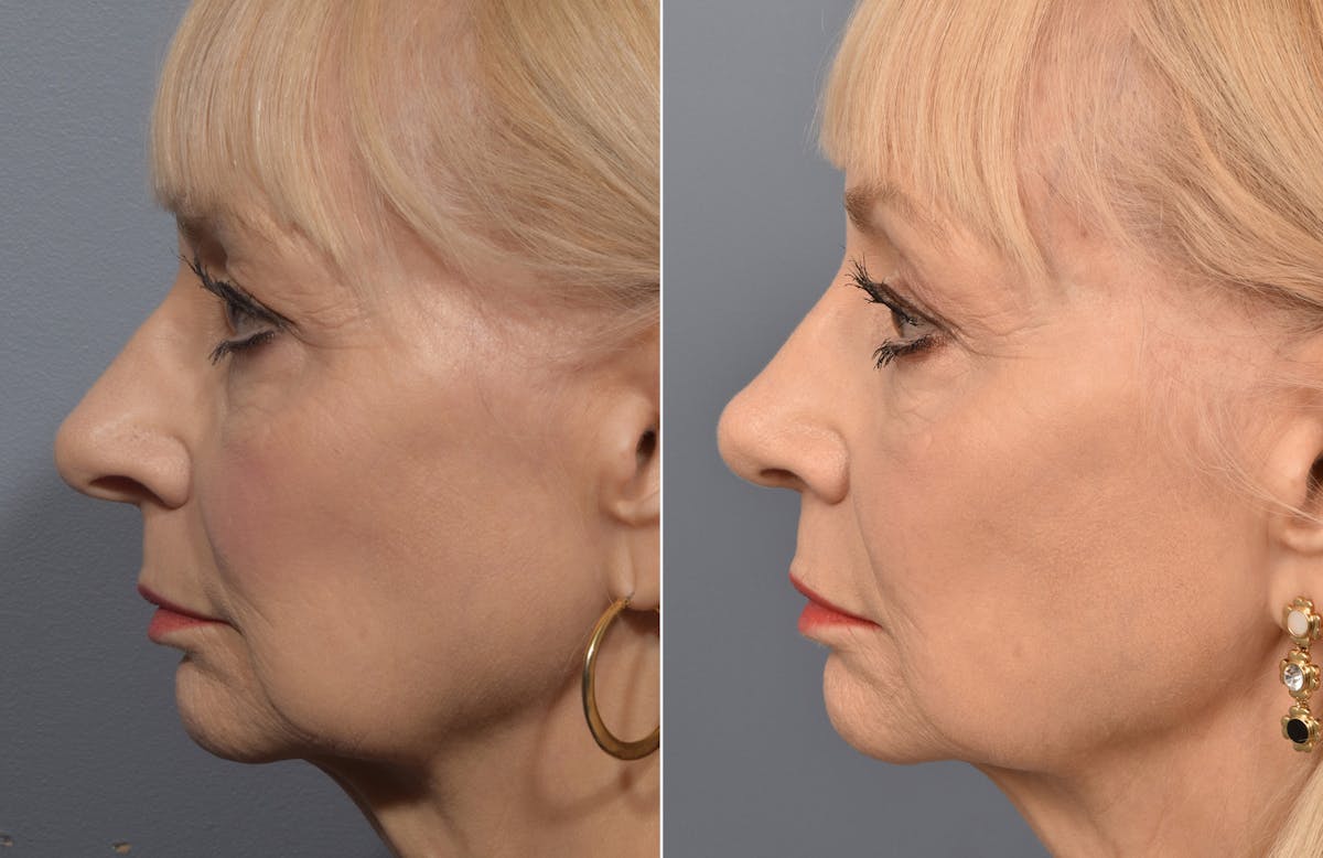 Rhinoplasty Before & After Gallery - Patient 140831 - Image 5