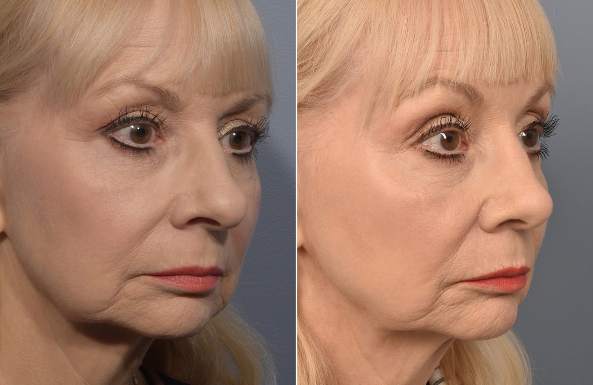Rhinoplasty Before & After Gallery - Patient 140831 - Image 3