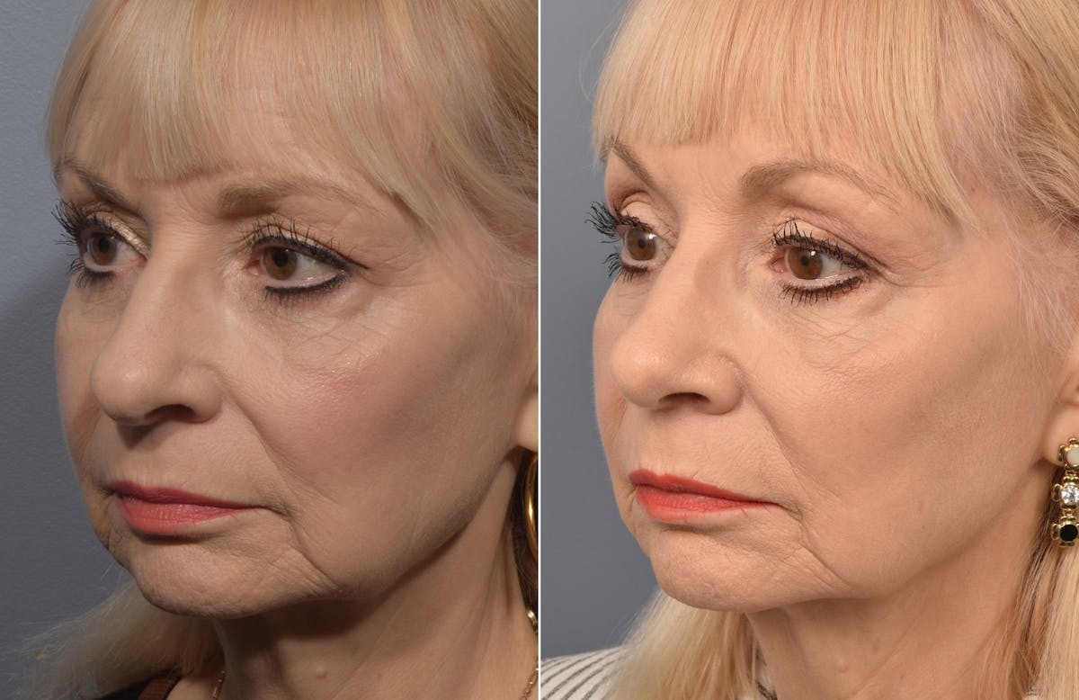 Rhinoplasty Before & After Gallery - Patient 140831 - Image 4
