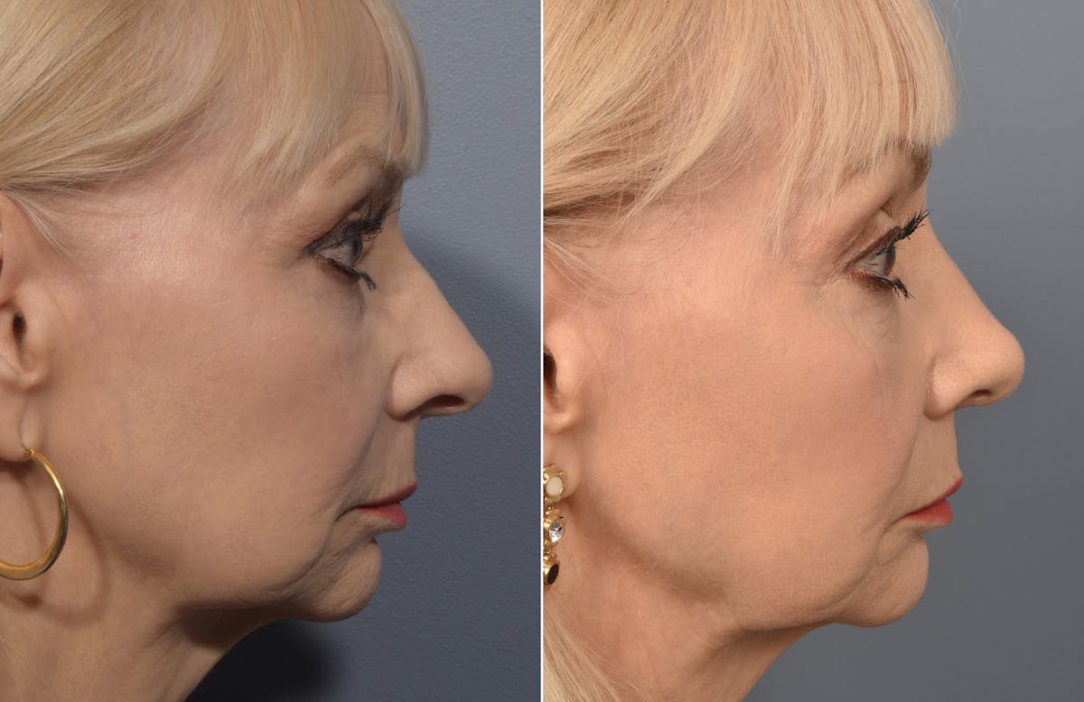 Rhinoplasty Before & After Gallery - Patient 140831 - Image 1