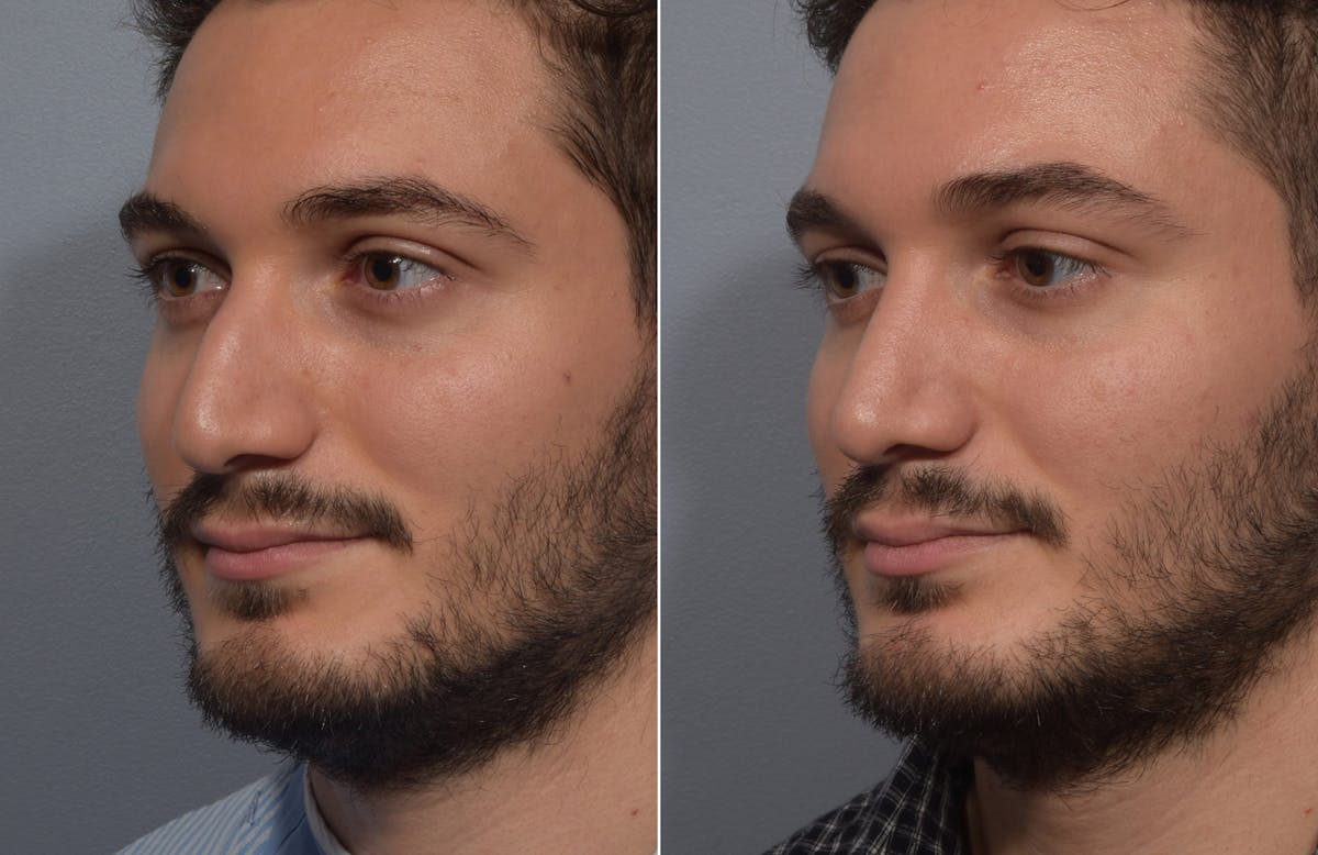 Rhinoplasty Before & After Gallery - Patient 389432 - Image 4