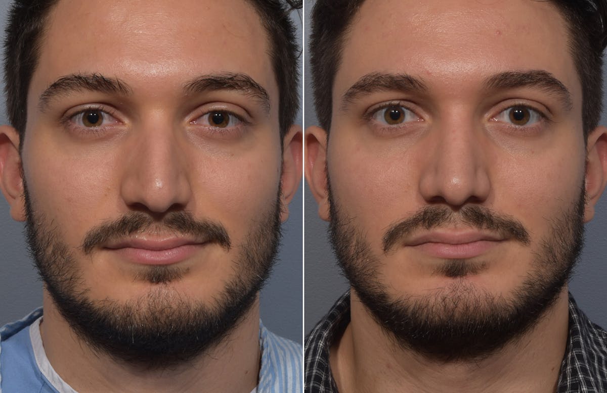 Rhinoplasty Before & After Gallery - Patient 389432 - Image 3
