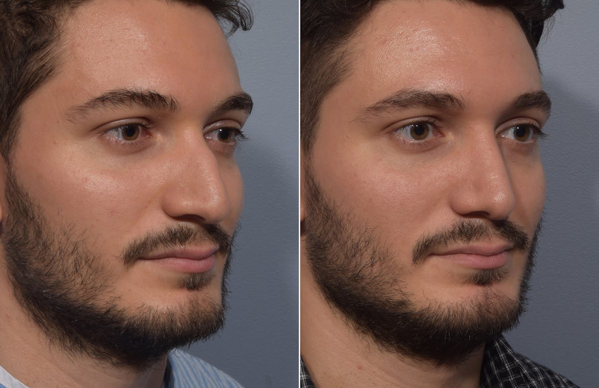 Rhinoplasty Before & After Gallery - Patient 389432 - Image 2