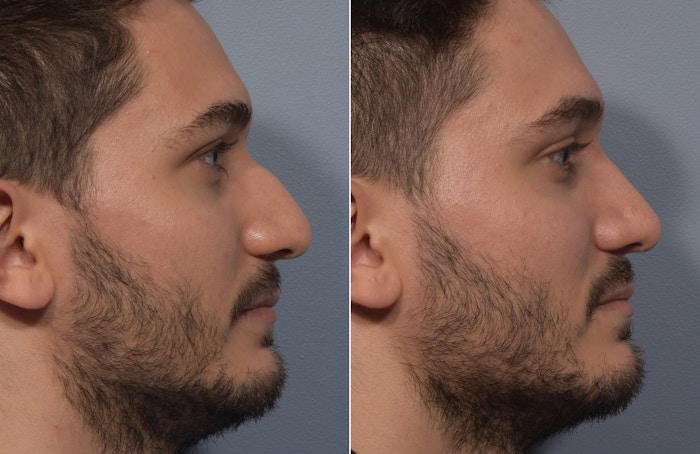 Rhinoplasty Before & After Gallery - Patient 389432 - Image 1