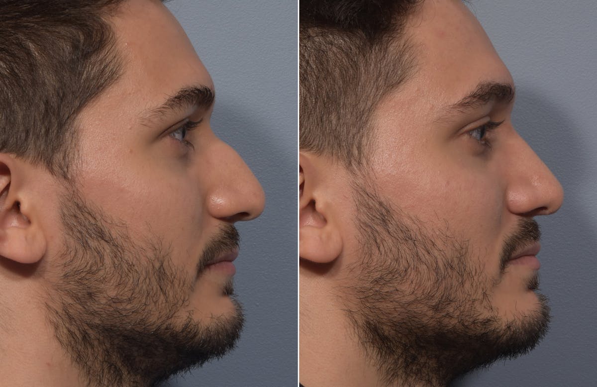 Rhinoplasty Before & After Gallery - Patient 389432 - Image 1