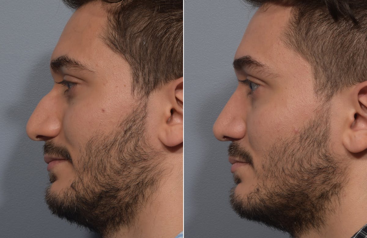 Rhinoplasty Before & After Gallery - Patient 389432 - Image 5