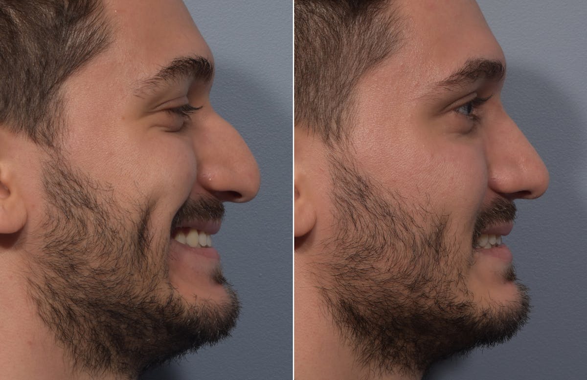 Rhinoplasty Before & After Gallery - Patient 389432 - Image 6