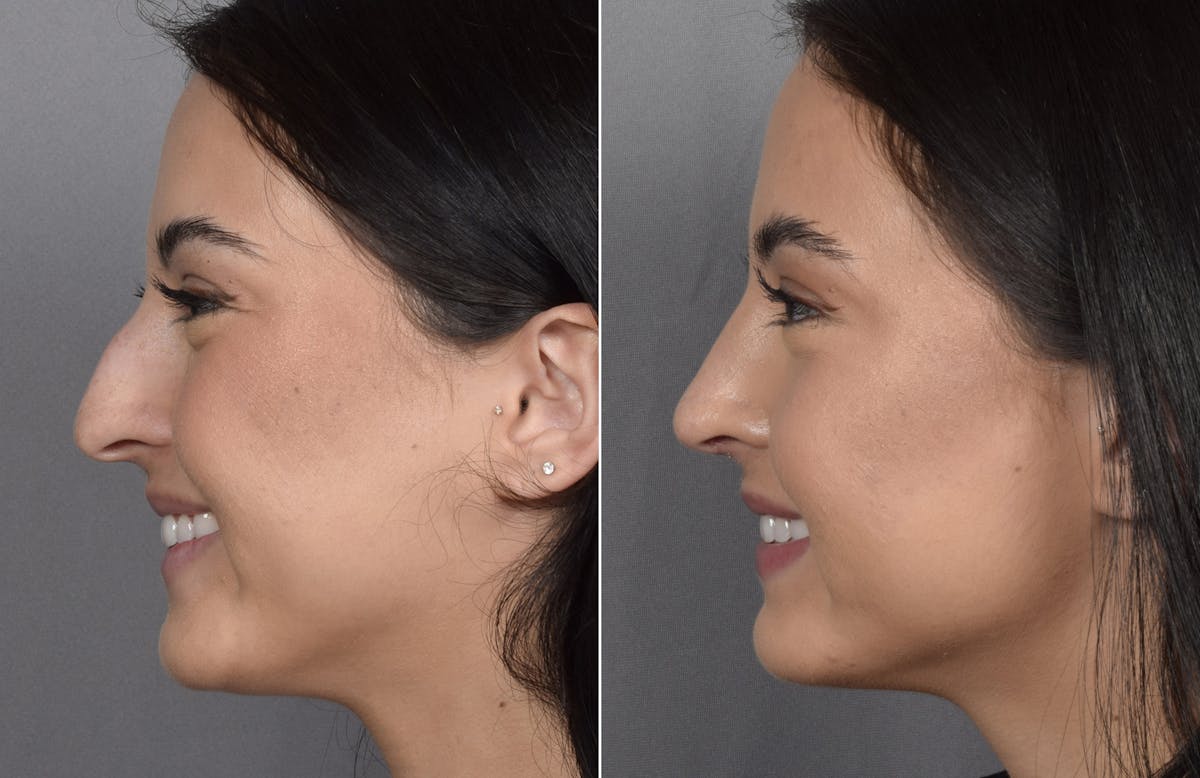 Rhinoplasty Before & After Gallery - Patient 368014 - Image 4